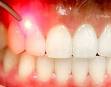 Лазерная имплантация зубов в Германии